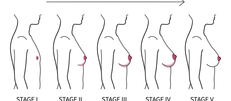 Tanner breast development stages I through V line art diagram