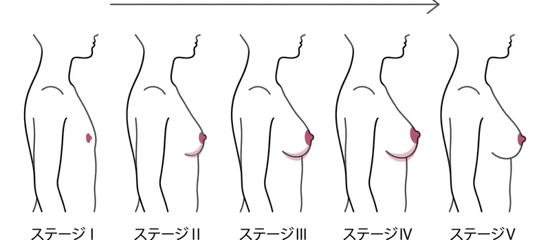 Tanner乳房発育段階I-V期の簡潔な輪郭線画