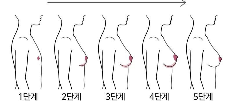 Tanner 유방 발달 단계 I-V기 윤곽 선화