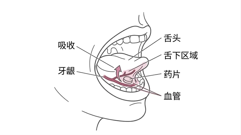 舌下含服位置示意图：药片放在舌下靠近牙龈处，经舌下黏膜血管吸收